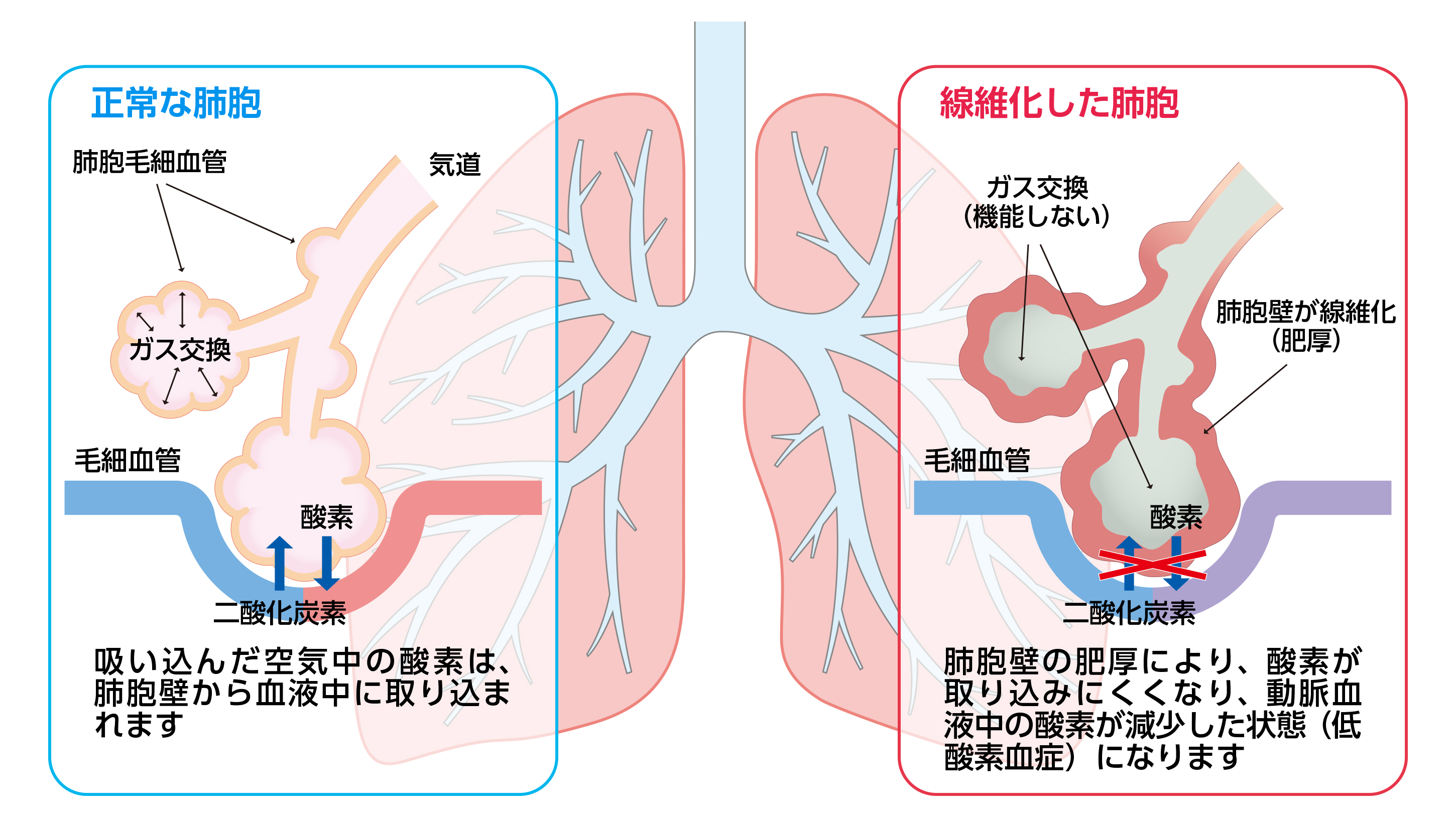 間質性肺炎 | ツムラ医療関係者向けサイト | 株式会社ツムラ